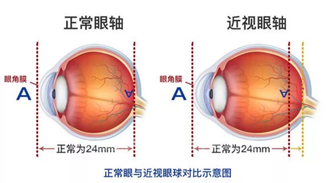 阜阳家长请注意!如果您家孩子眼睛