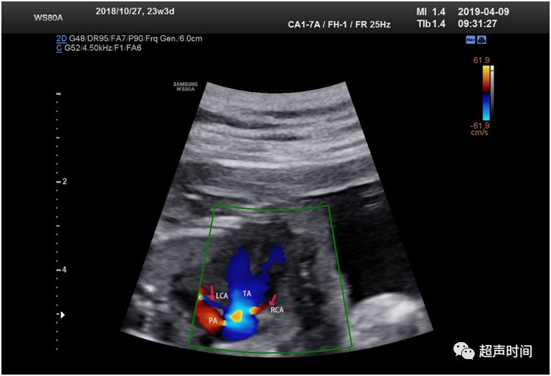 「钰」您谈心:胎儿永存动脉干畸形_超声
