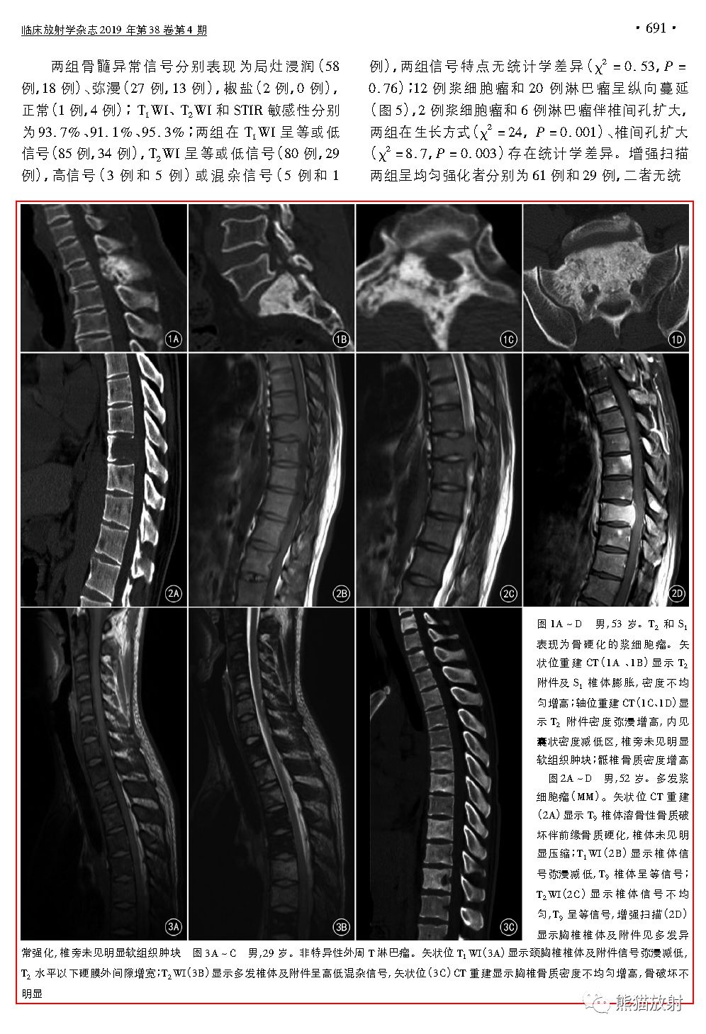 脊柱淋巴瘤和浆细胞瘤丨影像表现对比分析