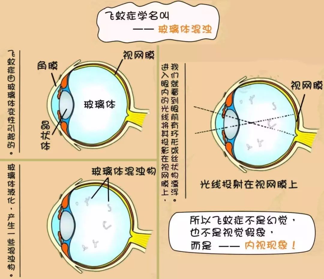 飞蚊症症状一般会以这三种方式呈现