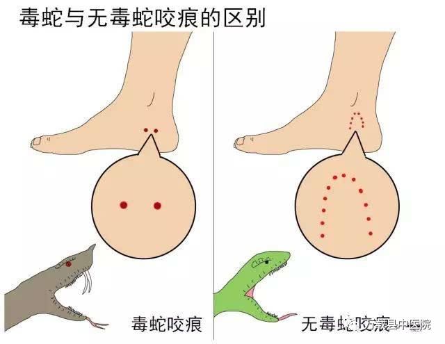 万载农妇被毒蛇咬伤夏季防蛇咬这样做