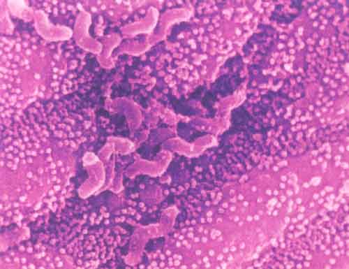 幽门螺杆菌感染症状表现,幽门螺杆菌如何根治