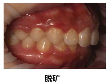 让口腔长时间处于酸性状态,对牙齿产生脱矿作用;而且长期喝含色素的