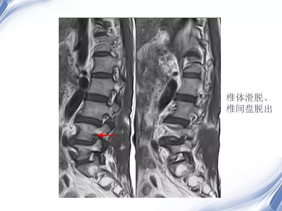 腰椎退行性变腰痛的mr诊断 | 影像天地