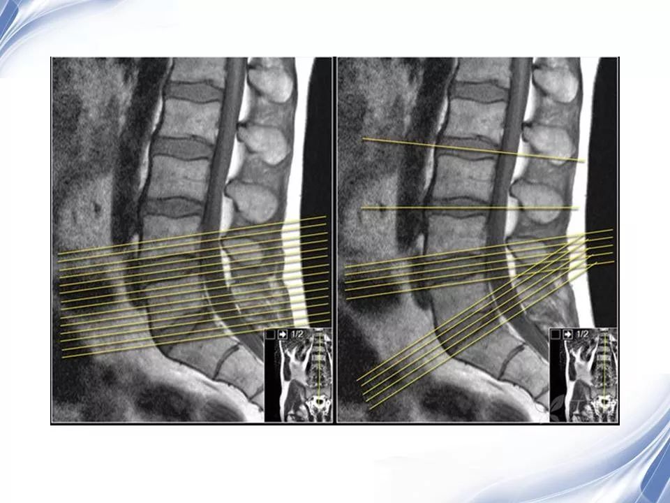 腰椎退行性变腰痛的mr诊断 | 影像天地