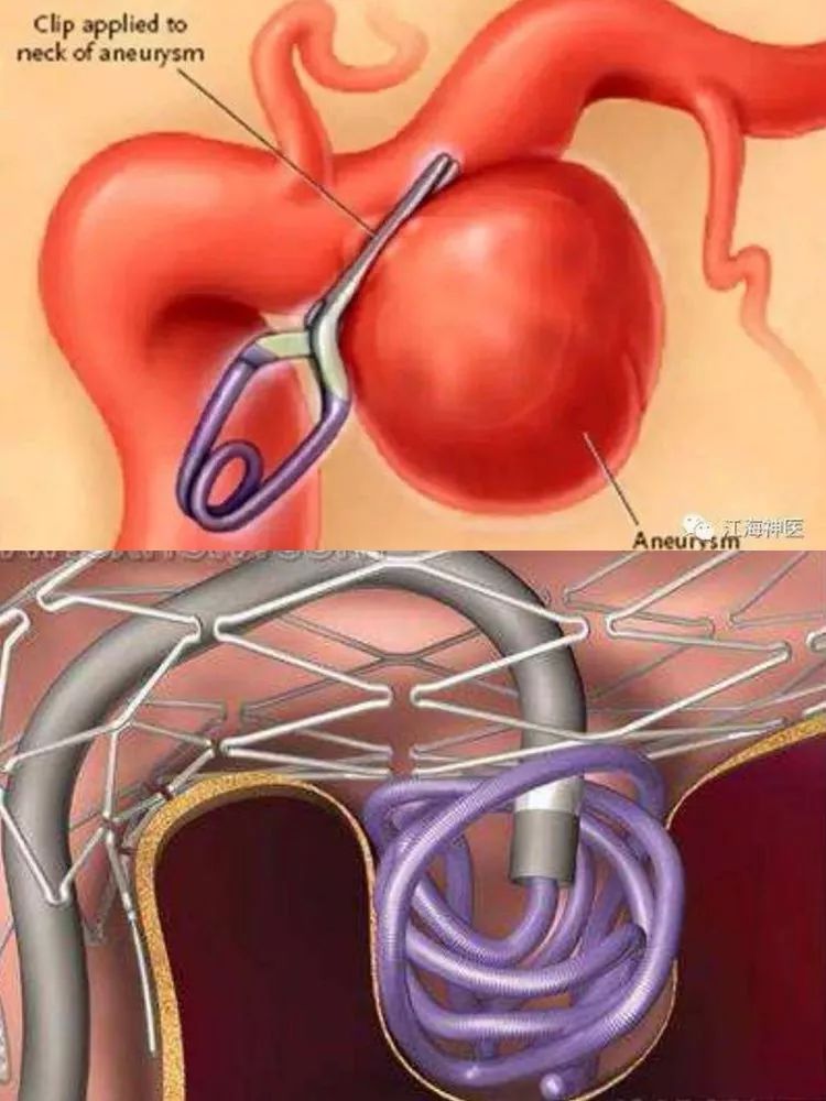 孙怀宇主任:颅内巨大动脉瘤行开颅夹闭/介入栓塞手术治疗体会