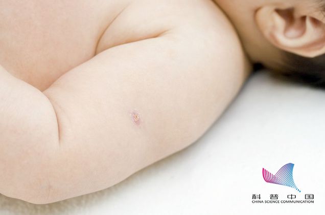 婴儿牛痘化脓怎么办