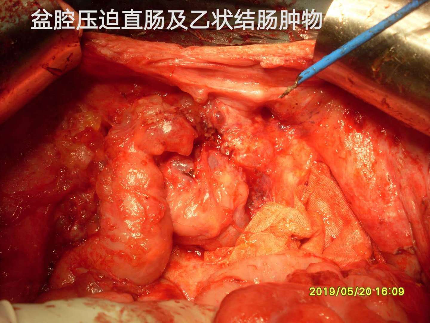 病例66--小阑尾大卵巢pmp晚期5次手术 (原创)