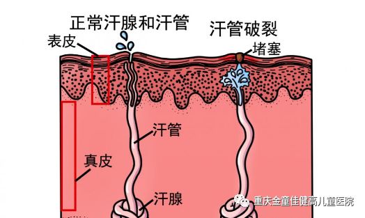 汗排不出来的话,造成汗腺堵塞,就容易起痱子.