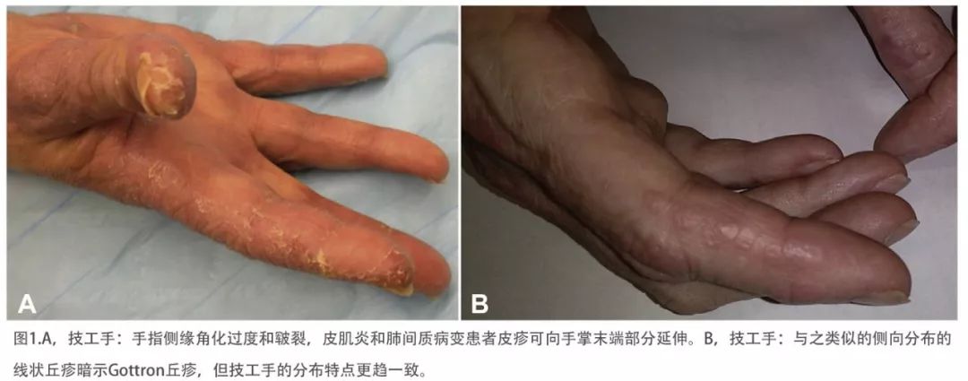 重新审视皮肌炎特异性皮肤表现—技工手