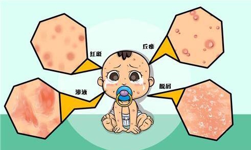 夏季天热,宝宝身上总起湿疹怎么办?了解这三点避免走入湿疹治疗误区!