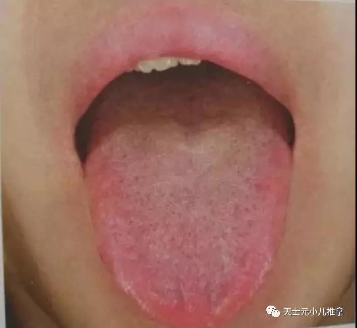 小孩子正常舌苔图片 91008a5631034d1a87a3a80fd55d9ec8.jpeg