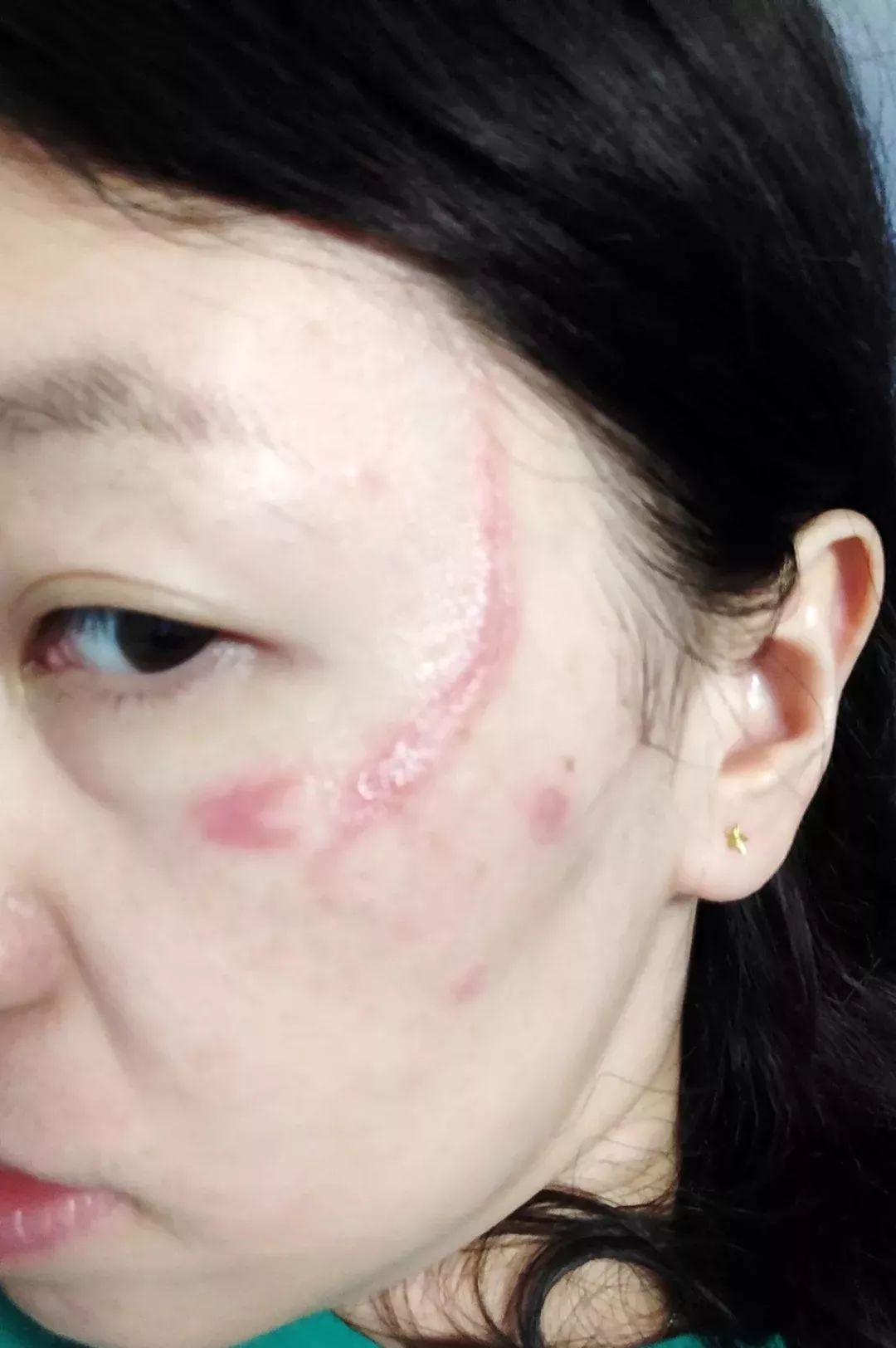                     3岁男孩被虫咬后器官衰竭，妈妈们认准这五种虫子！