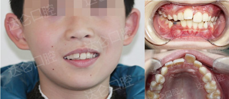 达仑口腔专家:早期矫治,让孩子远离错颌畸形