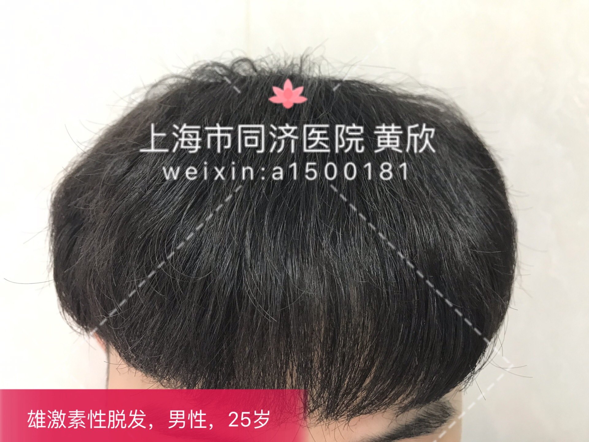 用什么方法可以不掉头发 c0561f5d44bc4cb7b67f648cf602c93c.jpeg