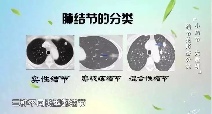 肺结节离肺癌有多远?除了定期复查,这种治疗方法或许有效!