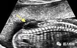注意胎儿骶尾部形态和皮肤