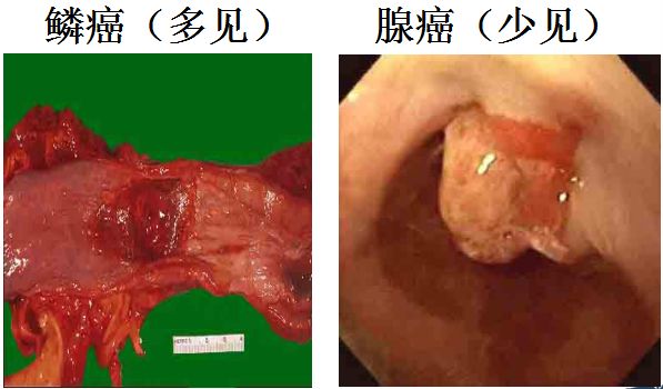 30 万人死于食管癌 男多于女,年龄> 40 岁, 我国是食管癌的高发区之一