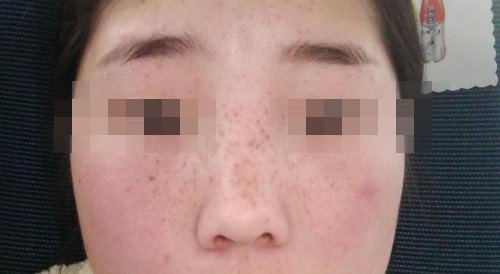 这种斑宝宝身上超过6个就要注意了! (原创)