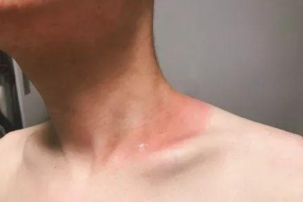 「晒伤急救」明星晒不黑的秘密!1支