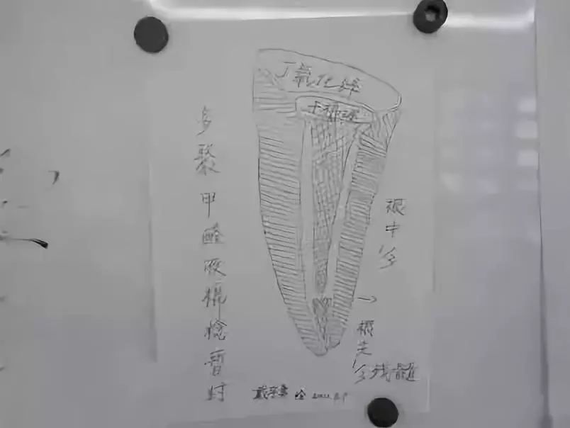 根管治疗时4种残髓处理方法