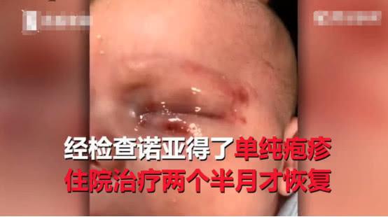                     原创            小宝宝被人亲了一下，不久后差点失明，住院两个半月才康复