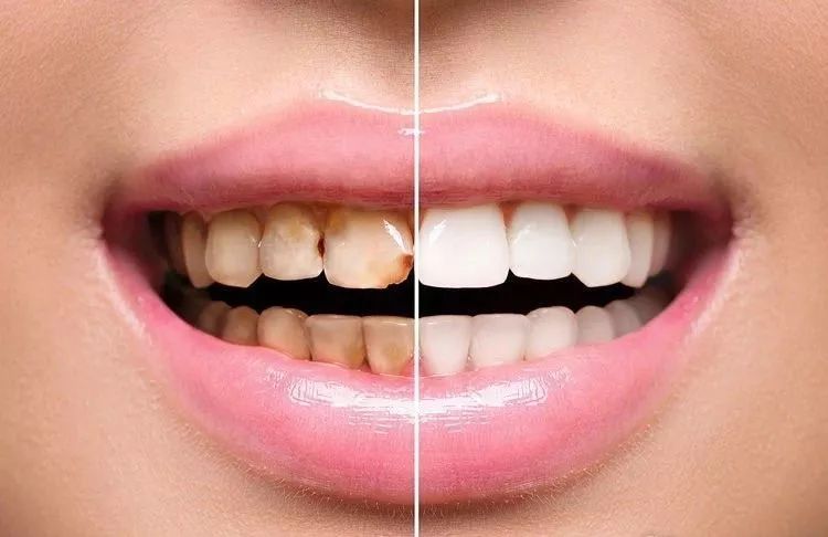 1,牙齿表面细菌过多 长期不注重口腔卫生的人,不经常刷牙或者是刷牙