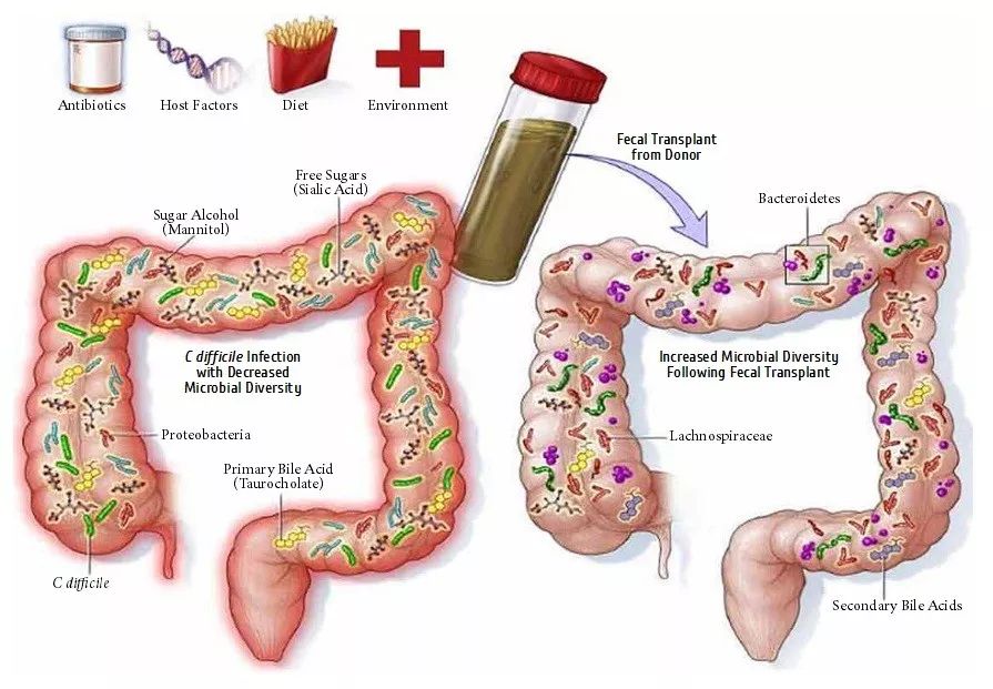 粪菌移植(fmt)是指将健康个体粪便中的功能菌落,移植到患者胃肠道内
