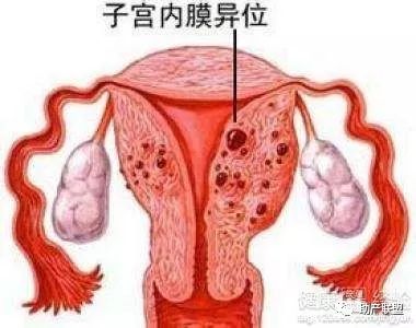 子宫内膜异位症与生育