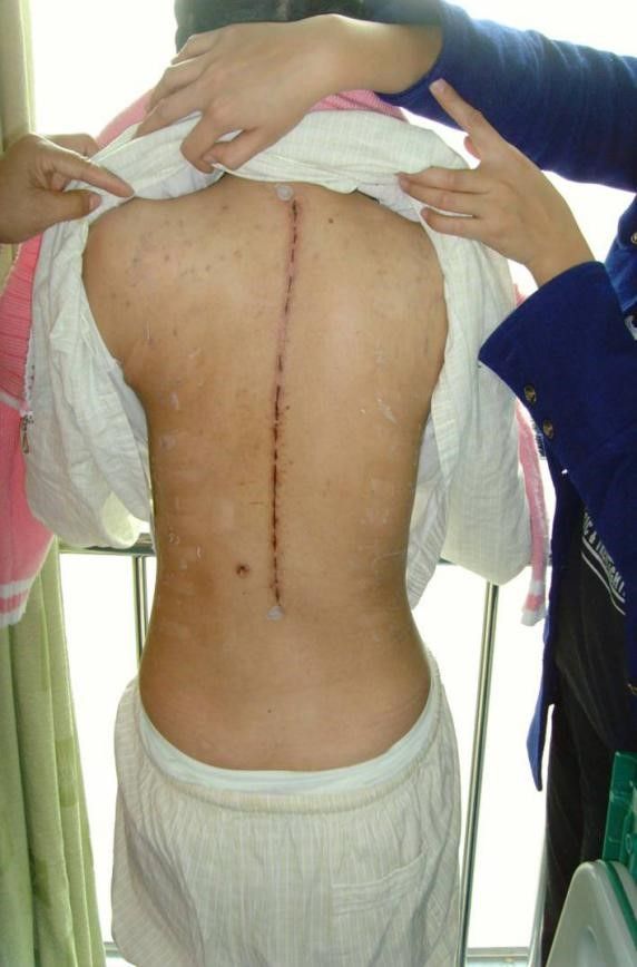 青少年特发性脊柱侧凸的微创治疗——上海市一付强教授科普系列