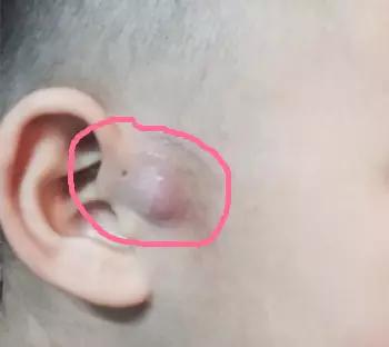                     为什么宝宝耳朵旁边有个小洞？还会流脓，医生说要切除...