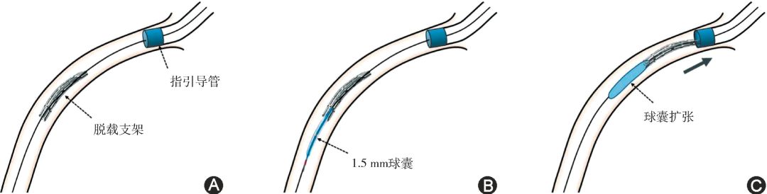 采用小球囊技术处理Ⅰa型支架脱载示意图