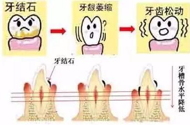 牙结石还分种类如何判断自己是否有牙结石牙结石的危害