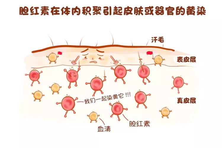 低下及 排泄障碍会导致血清胆红素异常增高,甚至可以引起胆红素脑病