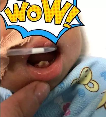为什么新生儿长马牙 新生儿竟然长了两颗牙，不是马牙 那是啥呀？