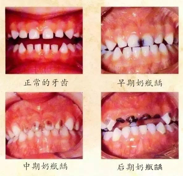                    婴儿不到一岁牙齿全部掉光！只因宝妈错误使用奶嘴...