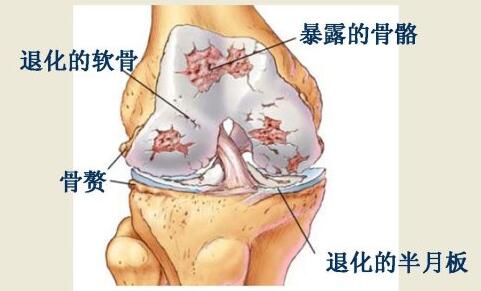 比如,常见的膝关节伤害有半月板损伤,髌骨软化症,髂胫束症候群以及