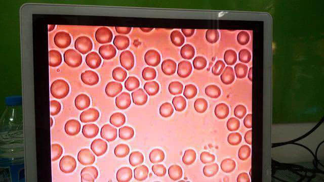 显微镜下的血液,血液粘稠度太高,导致血液循环变差.