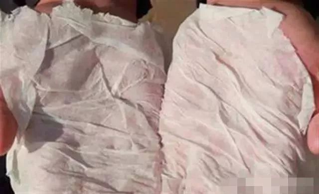 双手出汗像滴水纸巾都打湿了湖北女白领因此患上社交恐惧症