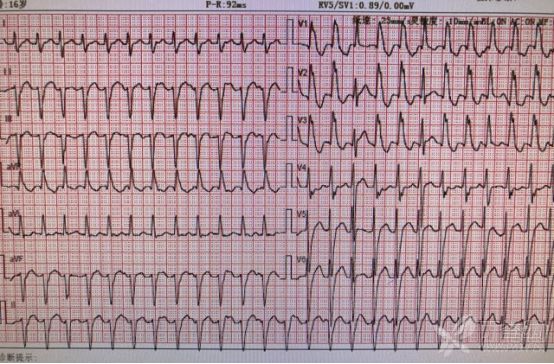 窦性夺获 or 室性夺获 or 室性融合波?别再傻傻分不清楚!