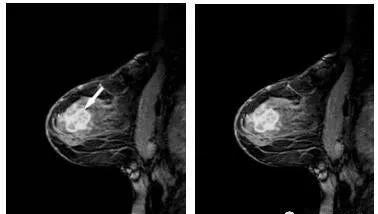 乳腺增生和乳腺炎的疼痛一样吗?3大特点教你区分