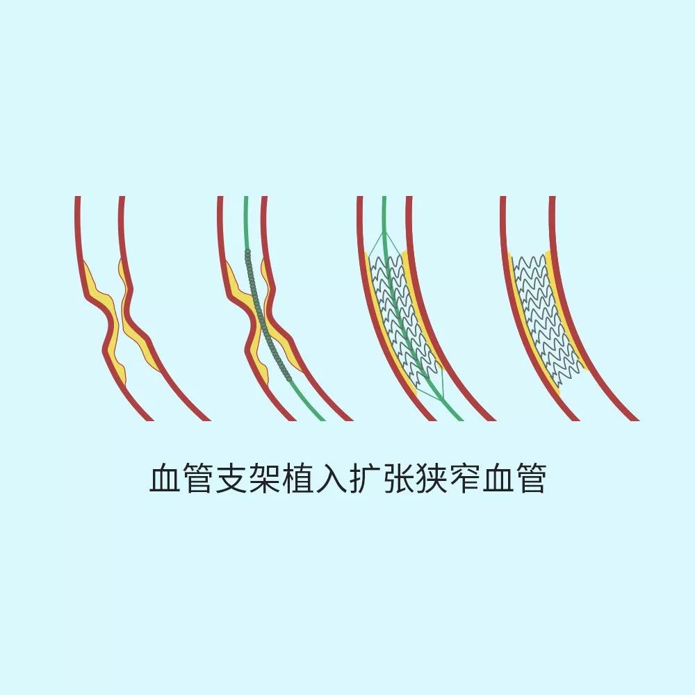 根据目前的临床随访情况来看,国产支架与进口支架实际疗效已经没有太