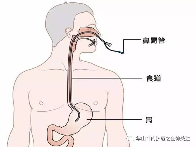 重症肌无力患者的胃管护理