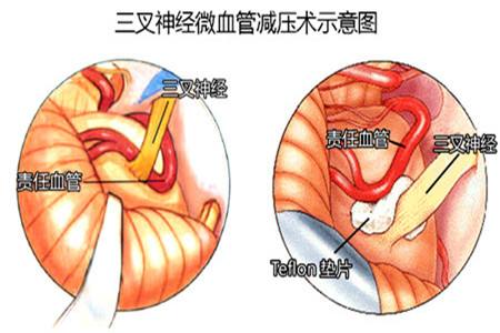 脸上肌肉跳动怎么办