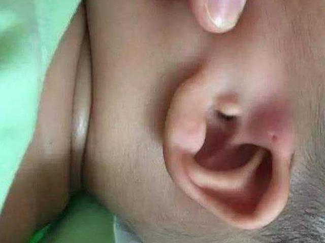 耳朵上小孔 宝宝耳朵生来有小孔，不一定是好事儿，家长要心里有数