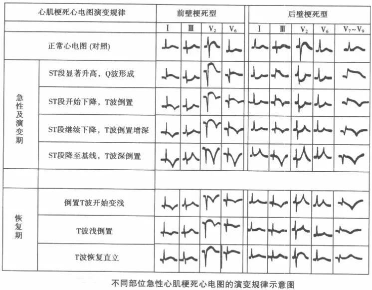 细数st段抬高的n种原因,你可清楚?