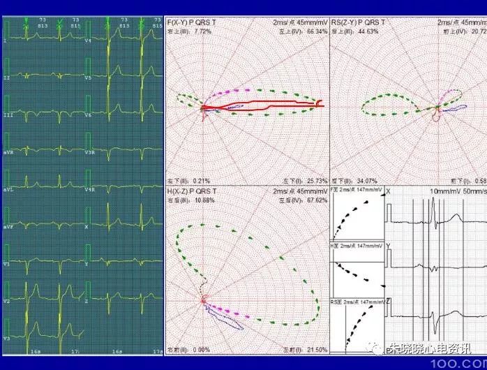 【yy语音】潘二明老师:心肌梗死的心电向量图特征2019