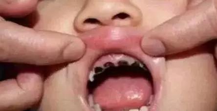                     婴儿不到一岁牙齿全部掉光！只因宝妈错误使用奶嘴...