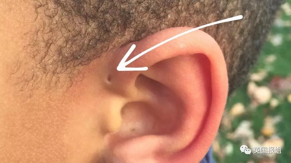 耳朵上有这个小洞，你就是天选之人了？！|耳朵上小洞