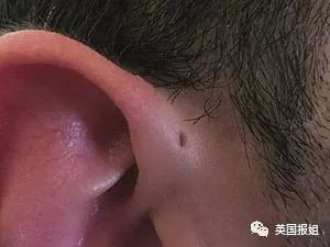                     耳朵上有这个小洞，你就是天选之人了？！